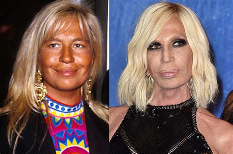 donatella versace prima chirurgia